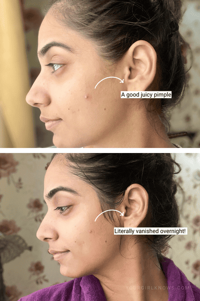 How to Get Rid of Pimples Overnight — 9 Dermatologist-Approved Secrets How to Get Rid of Pimples Overnight — 9 Dermatologist-Approved Secrets